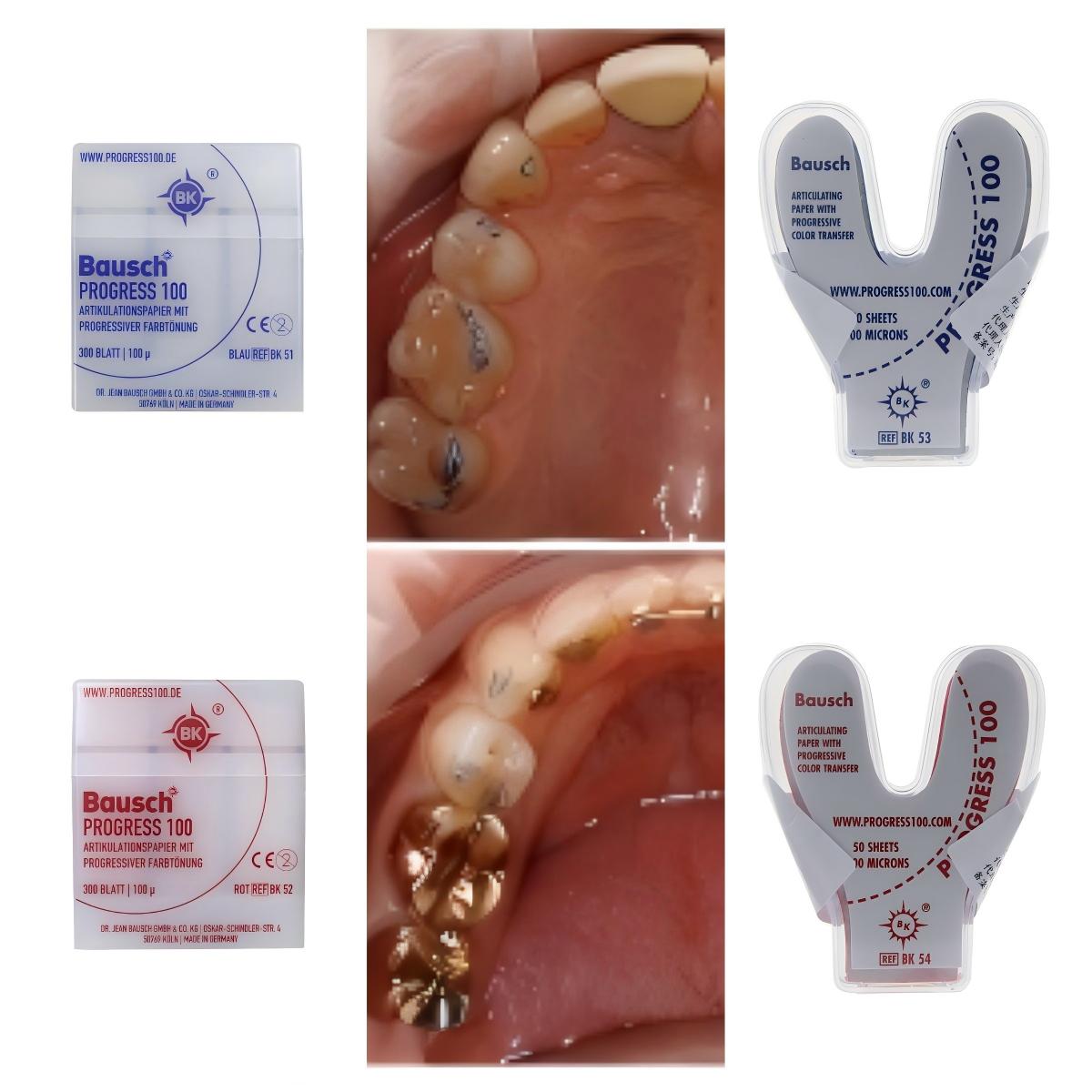 Bausch BK51 BK52 BK53 BK54 Den - Bite Indicator avaliação e preço